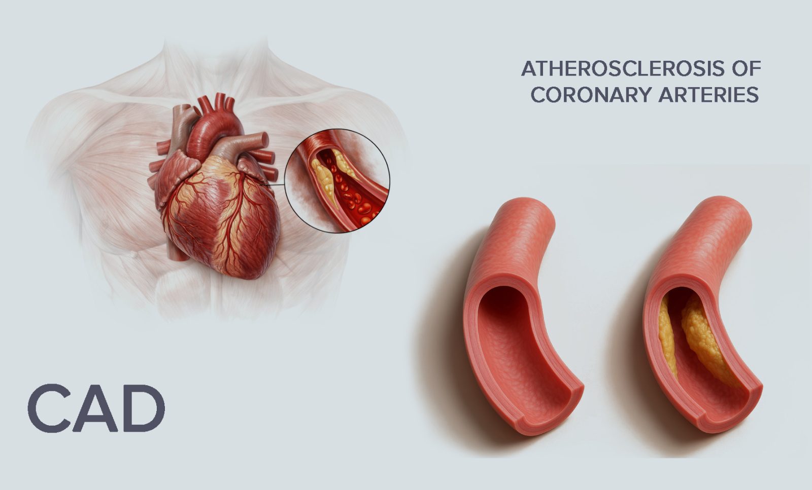 Atherosclerosis of coronary arteries